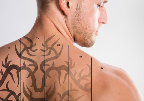 Laser Tattoo Removal - What Should I Consider Before Going Ahead?